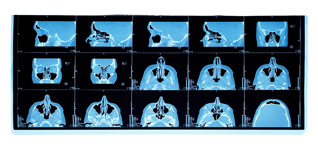 How Do I Prepare for a Sinus CT Scan