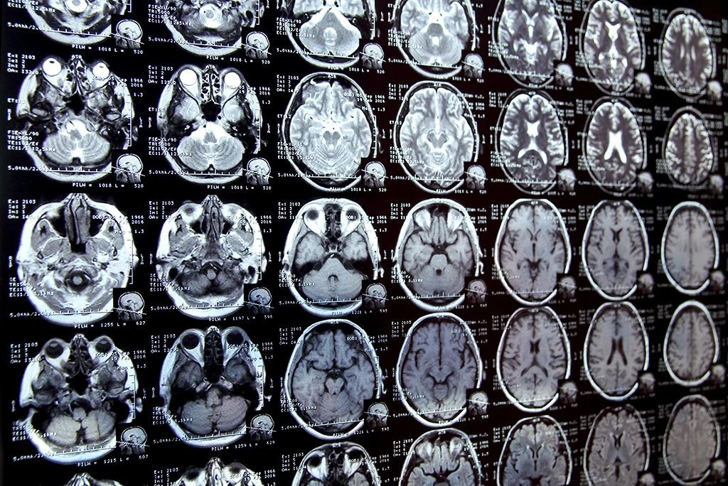 Can an MRI Detect Long Haul COVID Symptoms?