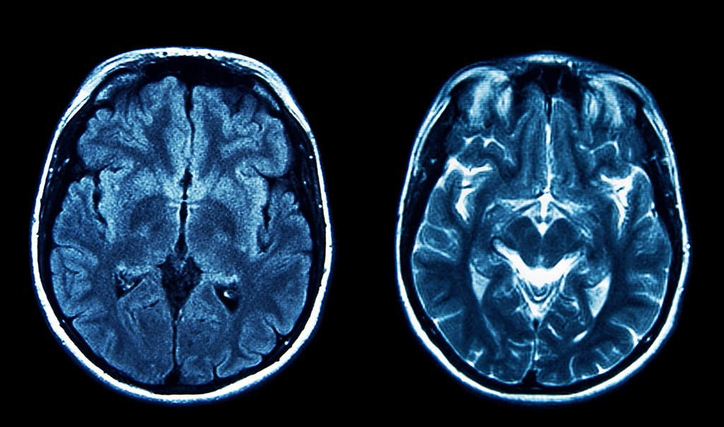 Can You See A Brain Tumor On An MRI Scan?