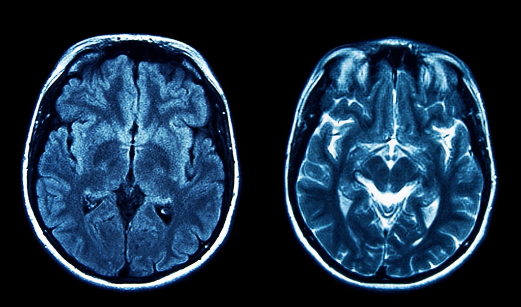 Side By Side View Of Brain MRI Scan Results