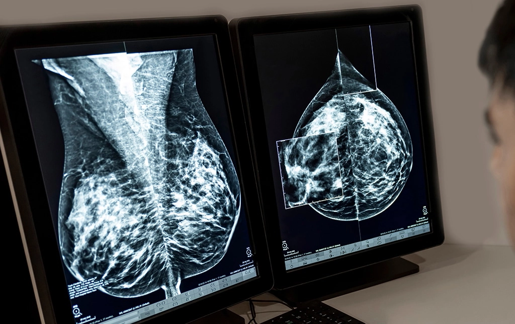 What to Know About the USPSTF New Draft Guidance For Mammograms