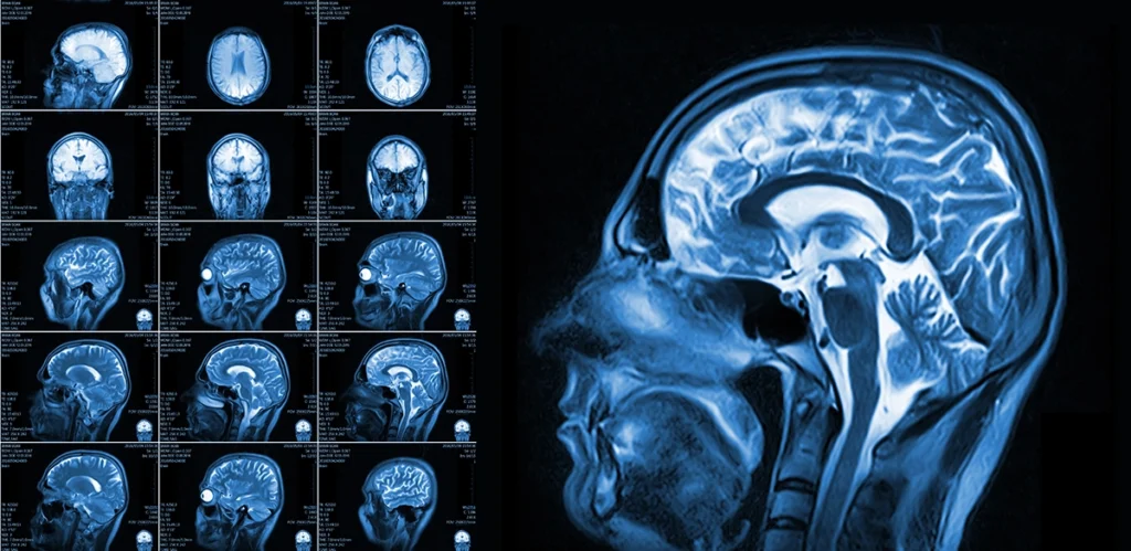 What Should I Know About My Brain MRI Results?