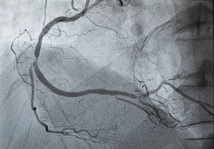 Angiogram Of Coronary Artery Results