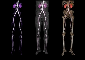 Angiogram Of Femoral Artery Results