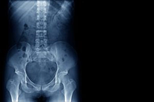 Bone Density DEXA Scan Results Of Hips