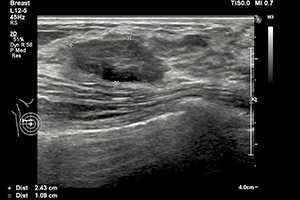 Breast Ultrasound Results