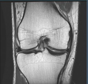 CT Arthrogram Of Knee