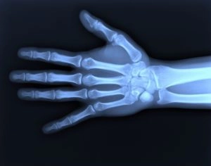 Digital X Ray Of Hand