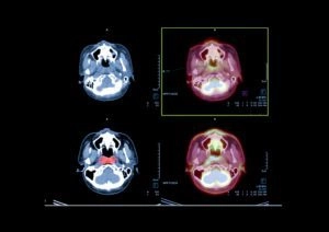 PET CT Images Of Brain