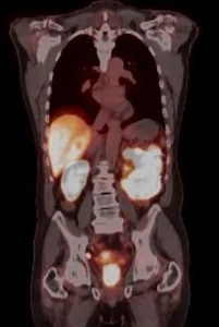 PET CT Image Of Prostate