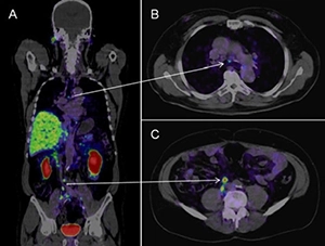 Pylarify PSMA PET CT Results